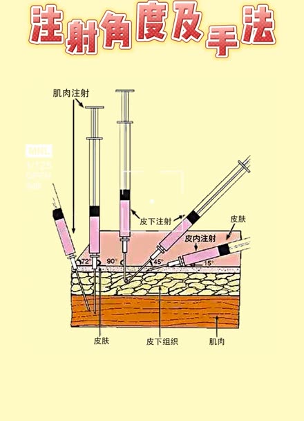 注射角度及手法