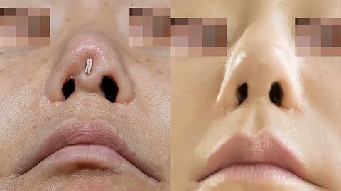 假体隆鼻中的假体穿出,典型的隆鼻失败