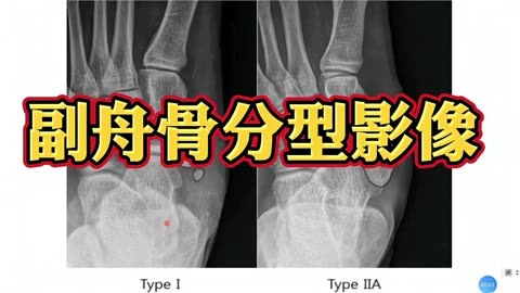 副舟骨x线图片图片