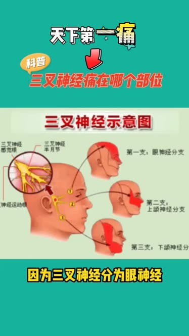 三叉神经位置图片